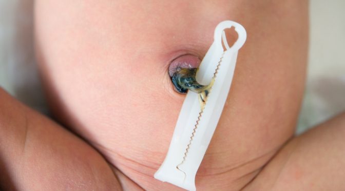 Vergiß die Nabelklemme! Nabelschnurklemmen sind unnatürlich und manipulieren die Physiologie der Geburt.